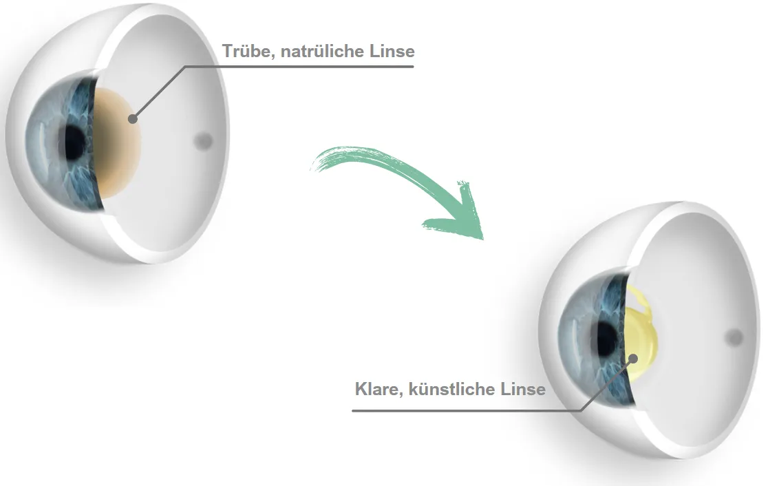 Linsentausch – tr&uuml;be vs. klare Linse