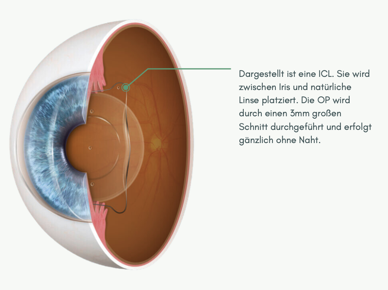 ICL Anatomie – Platzierung zwischen Iris und Linse
