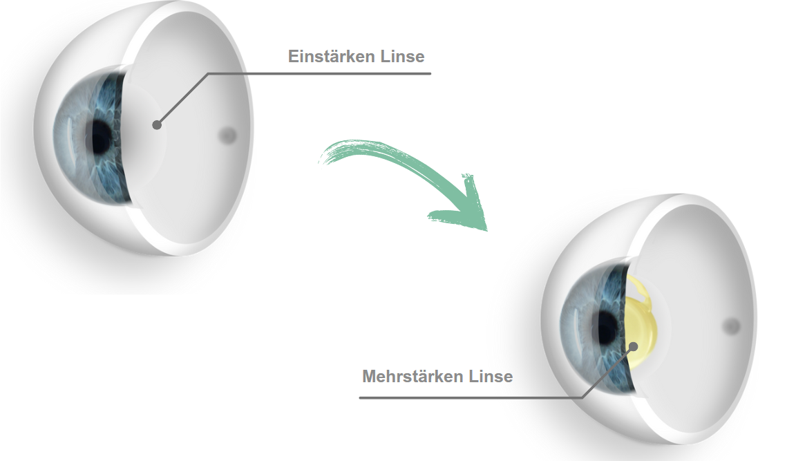 Linsentausch: Einstärken- vs. Mehrstärkenlinse