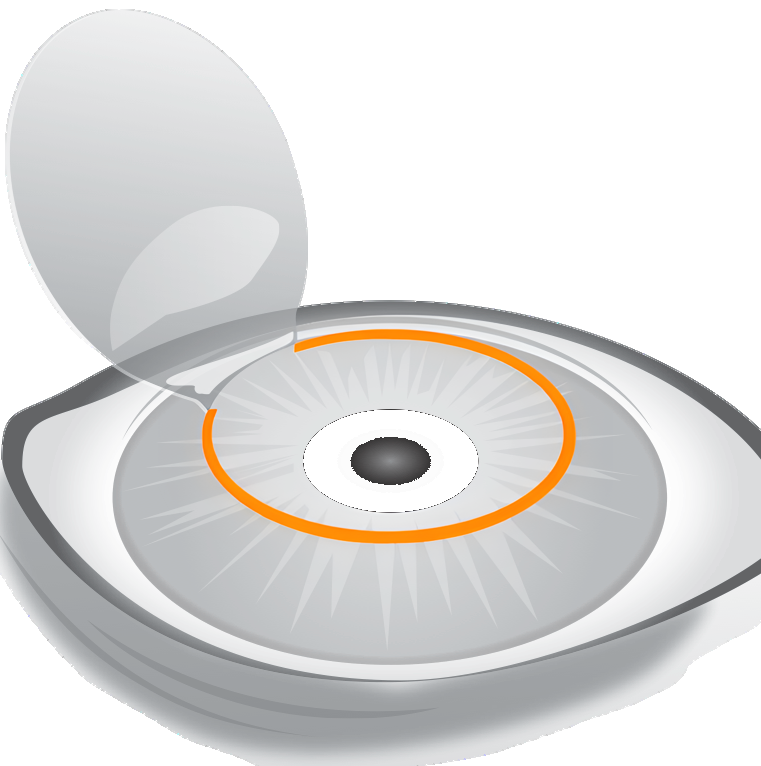 Femto-LASIK vs SMILE PRO Vergleich